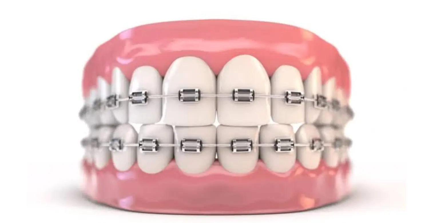 What Are Orthodontic Braces Made Of 2